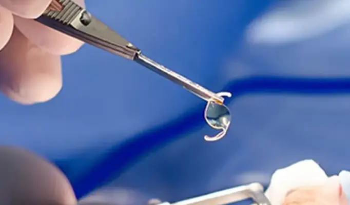 What is intraocular lens implantation_
