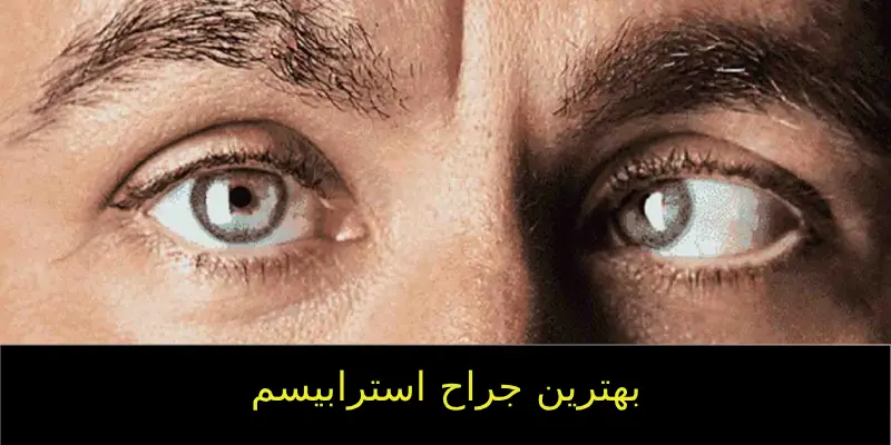 بهترین جراح استرابیسم