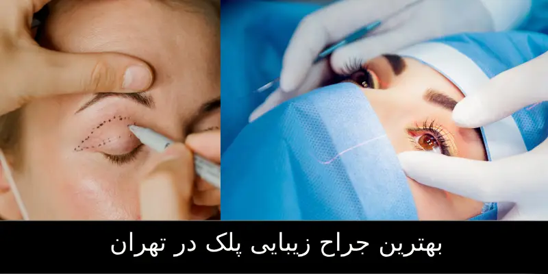 بهترین جراح زیبایی پلک(بلفاروپلاستی)