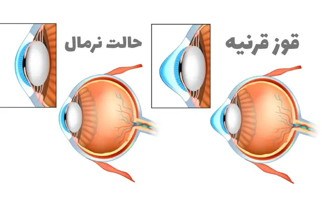 قوز قرنیه