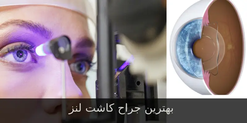 بهترین جراح کاشت لنز icl 