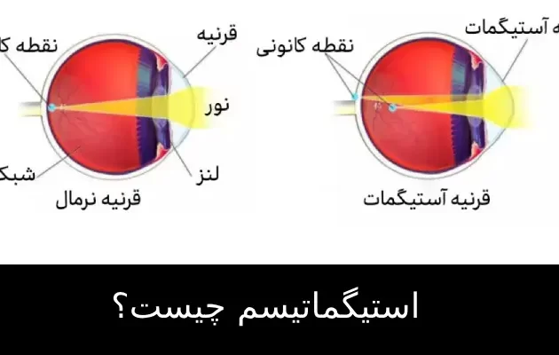 استیگماتیسم چیست؟