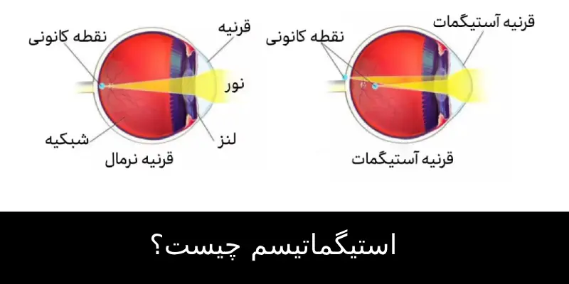 استیگماتیسم چیست؟