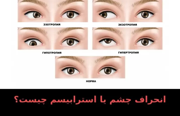 انحراف چشم یا استرابیسم چیست؟