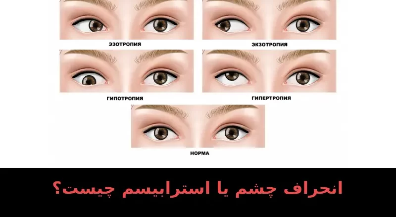 انحراف چشم یا استرابیسم چیست؟