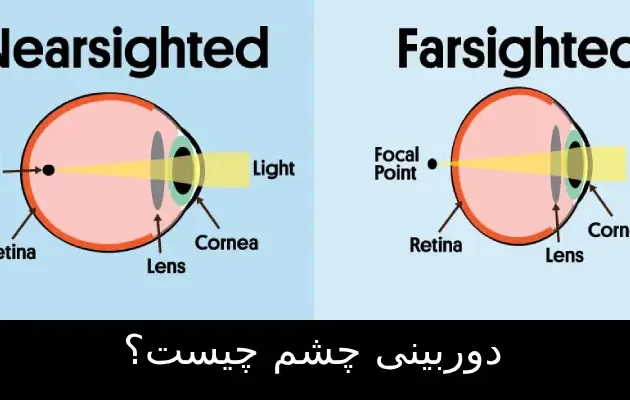 دوربینی چشم چیست؟