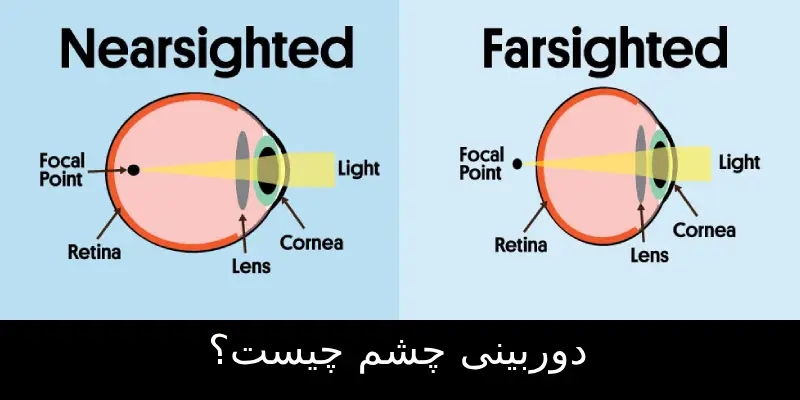 دوربینی چشم چیست؟