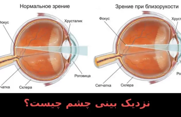 نزدیک بینی چشم چیست؟