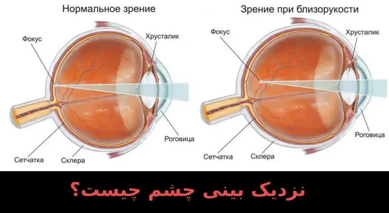 نزدیک بینی چشم چیست؟
