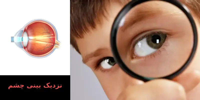 نزدیک بینی چشم چیست؟