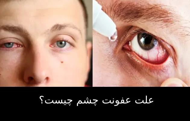 علت عفونت چشم