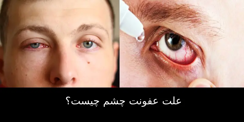 علت عفونت چشم