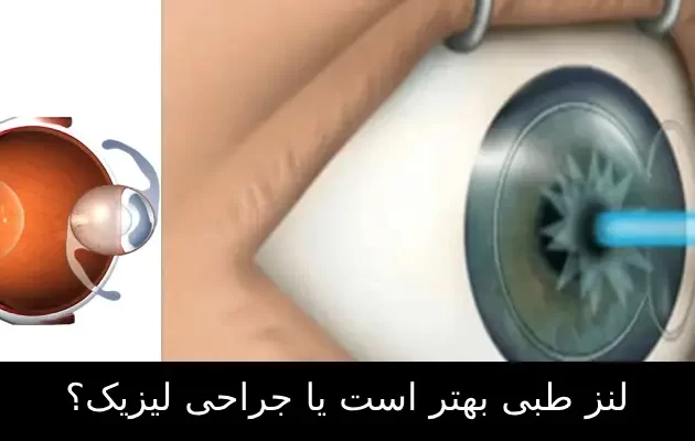 لنز طبی بهتر است یا جراحی لیزیک؟