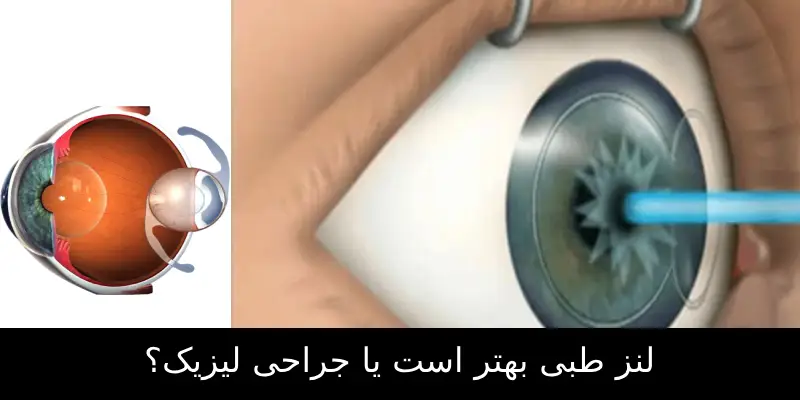 لنز طبی بهتر است یا جراحی لیزیک؟