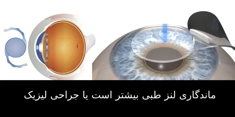 لنز طبی بهتر است یا جراحی لیزیک؟
