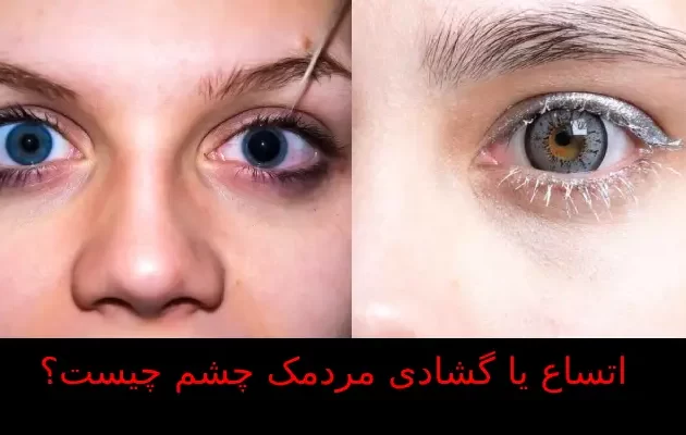 گشادی مردمک چشم چیست؟