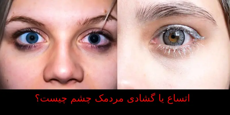 گشادی مردمک چشم چیست؟