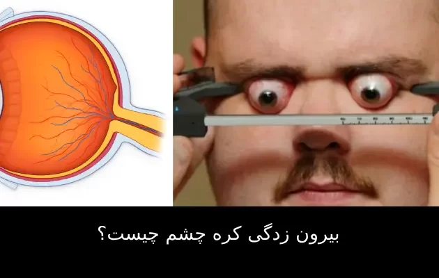 بیرون زدگی کره چشم