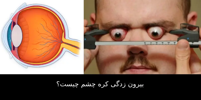 بیرون زدگی کره چشم