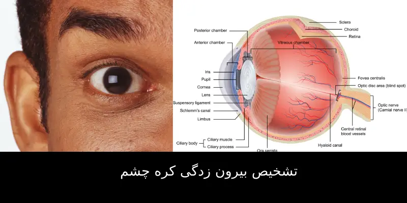 بیرون زدگی کره چشم