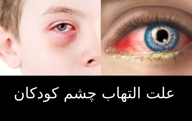 علت التهاب چشم کودکان
