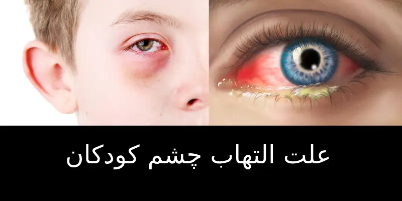 علت التهاب چشم کودکان