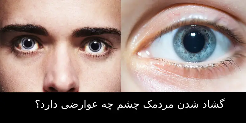 گشادی مردمک چشم چیست؟