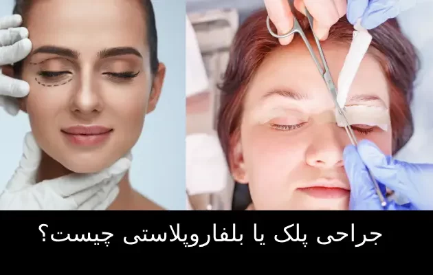 جراحی پلک یا بلفاروپلاستی چیست؟