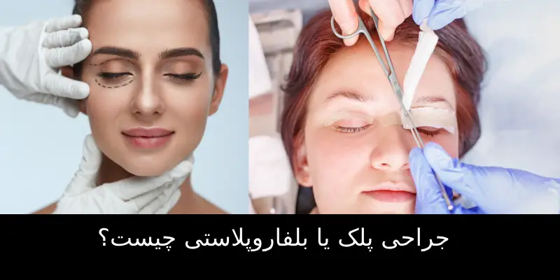 جراحی پلک یا بلفاروپلاستی چیست؟