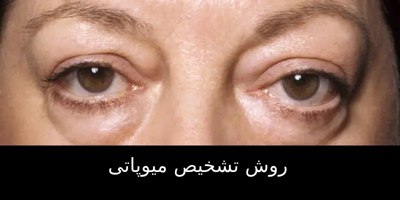 میوپاتی چشم چیست؟