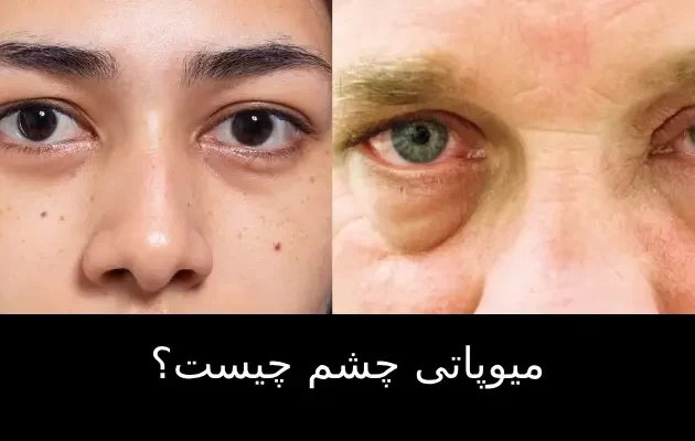 میوپاتی چشم چیست؟