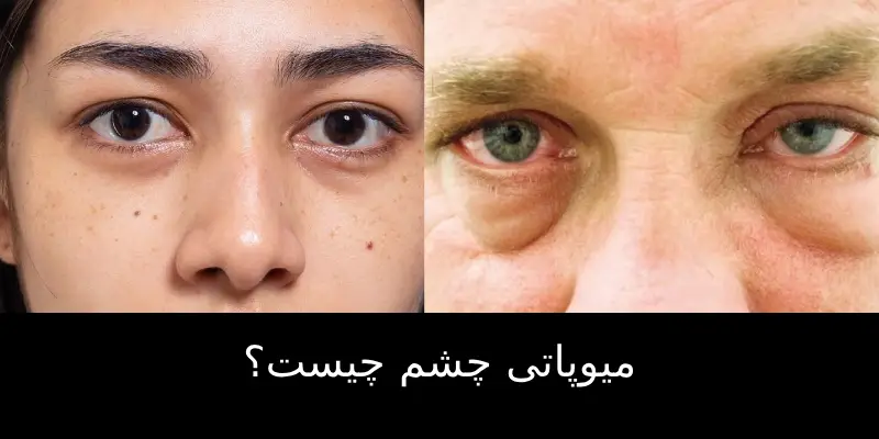 میوپاتی چشم چیست؟
