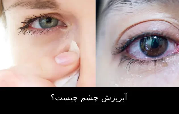 آبریزش چشم