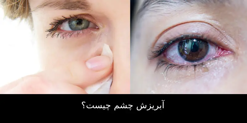 آبریزش چشم