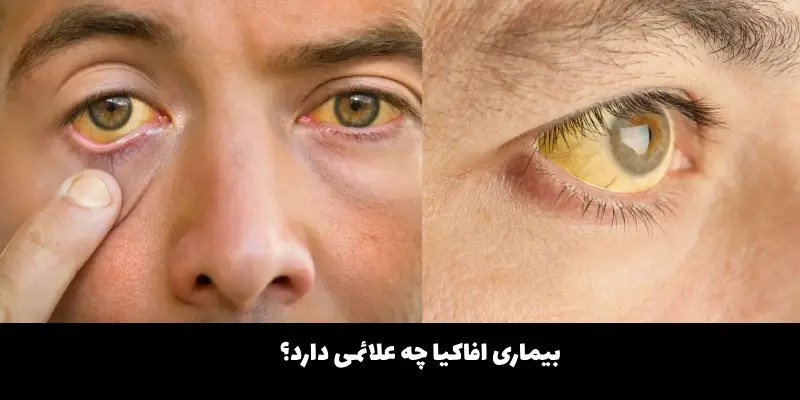 بیماری افاکیا چیست؟