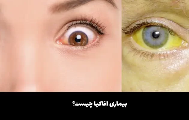 بیماری افاکیا چیست؟