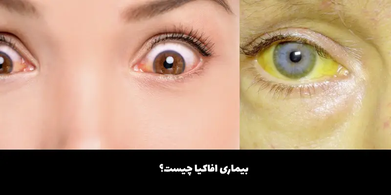 بیماری افاکیا چیست؟