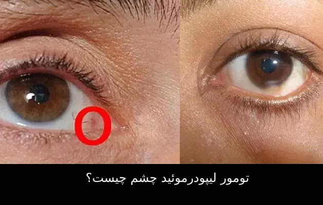 تومور لیپودرموئید چشم چیست؟