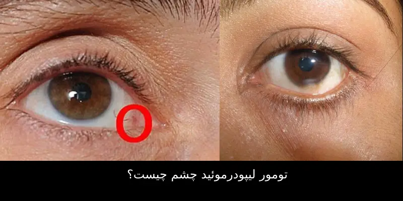 تومور لیپودرموئید چشم چیست؟