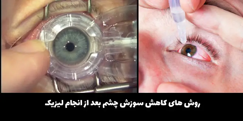 سوزش چشم بعد از عمل لیزیک