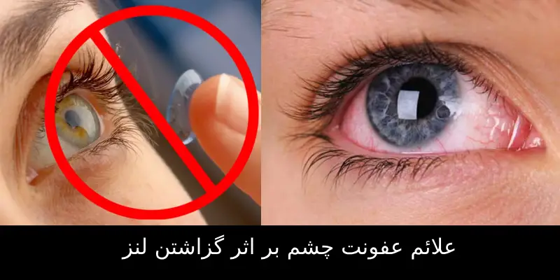 چرا لنز باعث عفونت چشم می‌شود؟