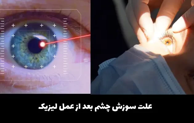 سوزش چشم بعد از عمل لیزیک