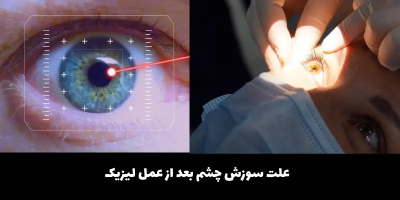سوزش چشم بعد از عمل لیزیک