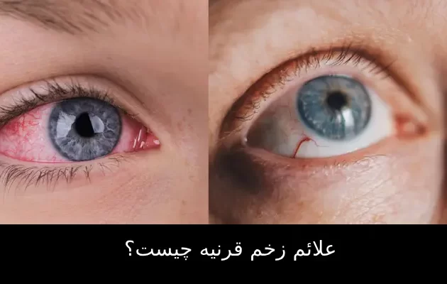 علائم زخم قرنیه