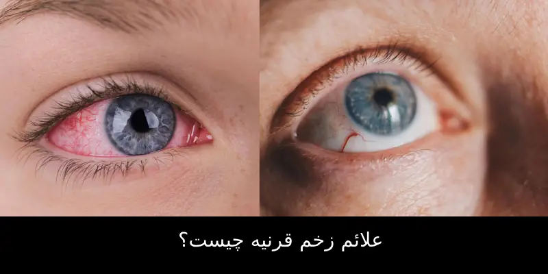 علائم زخم قرنیه