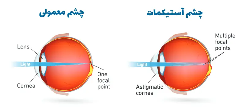 Astigmatism eye surgery