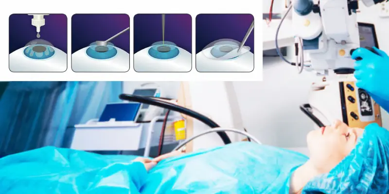 prk surgery