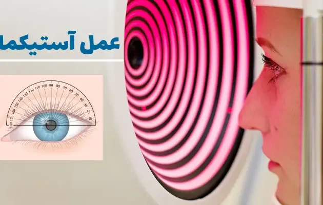 عمل چشم آستیگمات