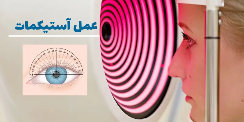 عمل چشم آستیگمات