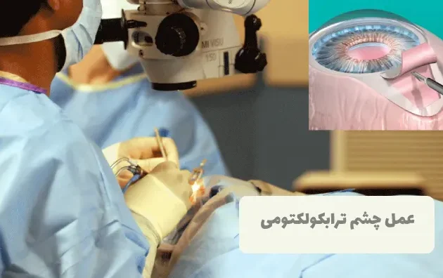 عمل ترابکولکتومی
